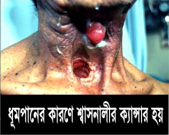 Bangladesh Health Effects Other - throat cancer, gross (Bengali)